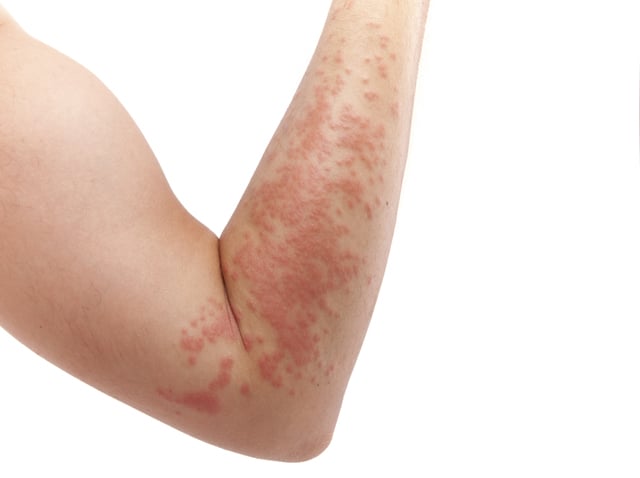 Rash: 7 Common Skin Rashes, Causes and Treatment